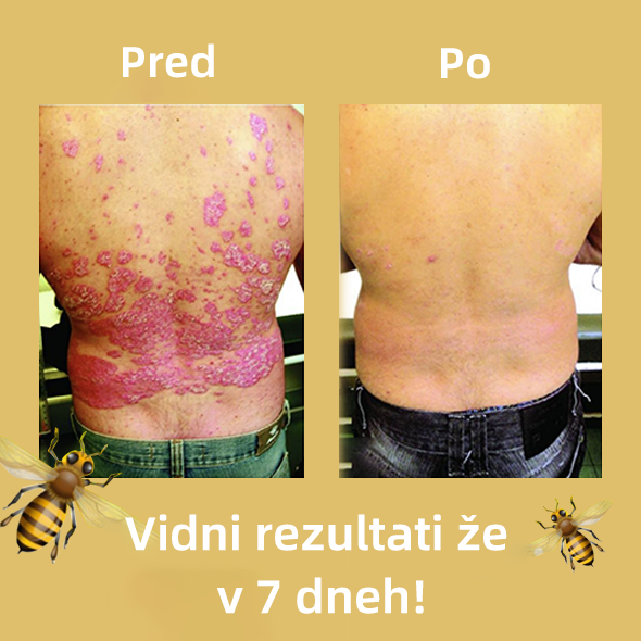 🌈Cvreoz krem za zdravljenje psorijaza z medonosjem (👨⚕Priporoča AAD)🐝🐝