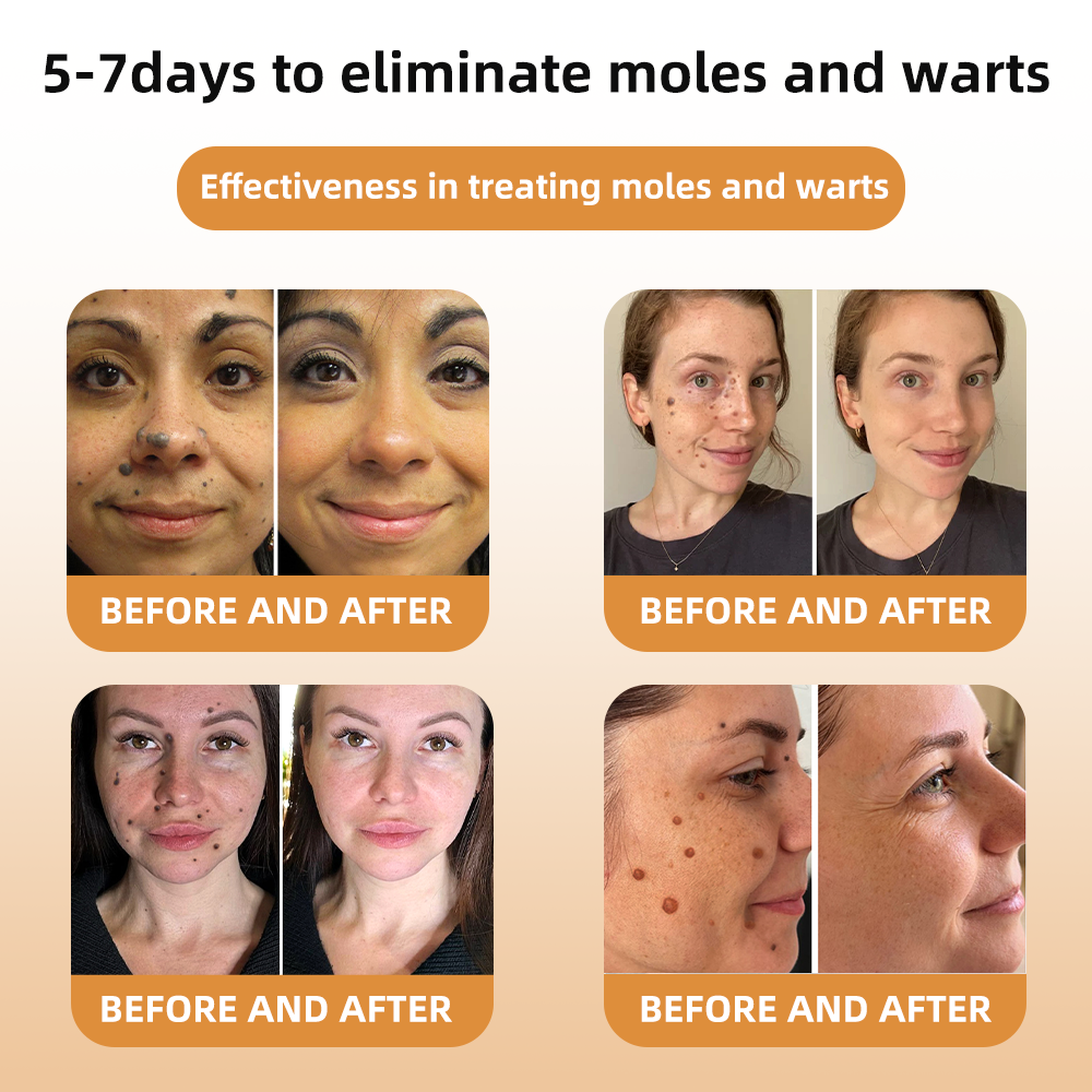 🐹WREE™ Bee Venom Wart & Tag Removal Cream(👨⚕Suitable for all skin types)🐝(🔥Last day promotion 60% off)
