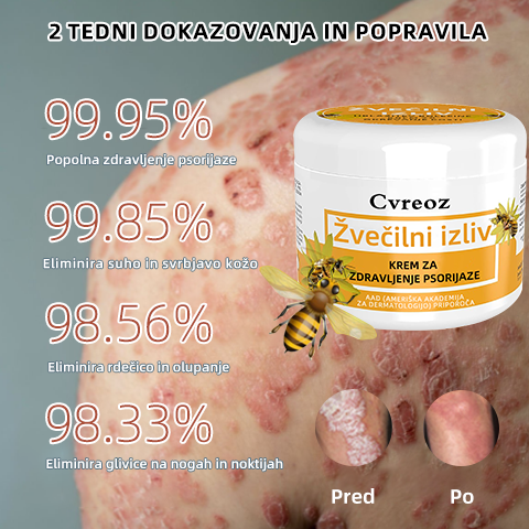 🌈Cvreoz krem za zdravljenje psorijaza z medonosjem (👨⚕Priporoča AAD)🐝🐝