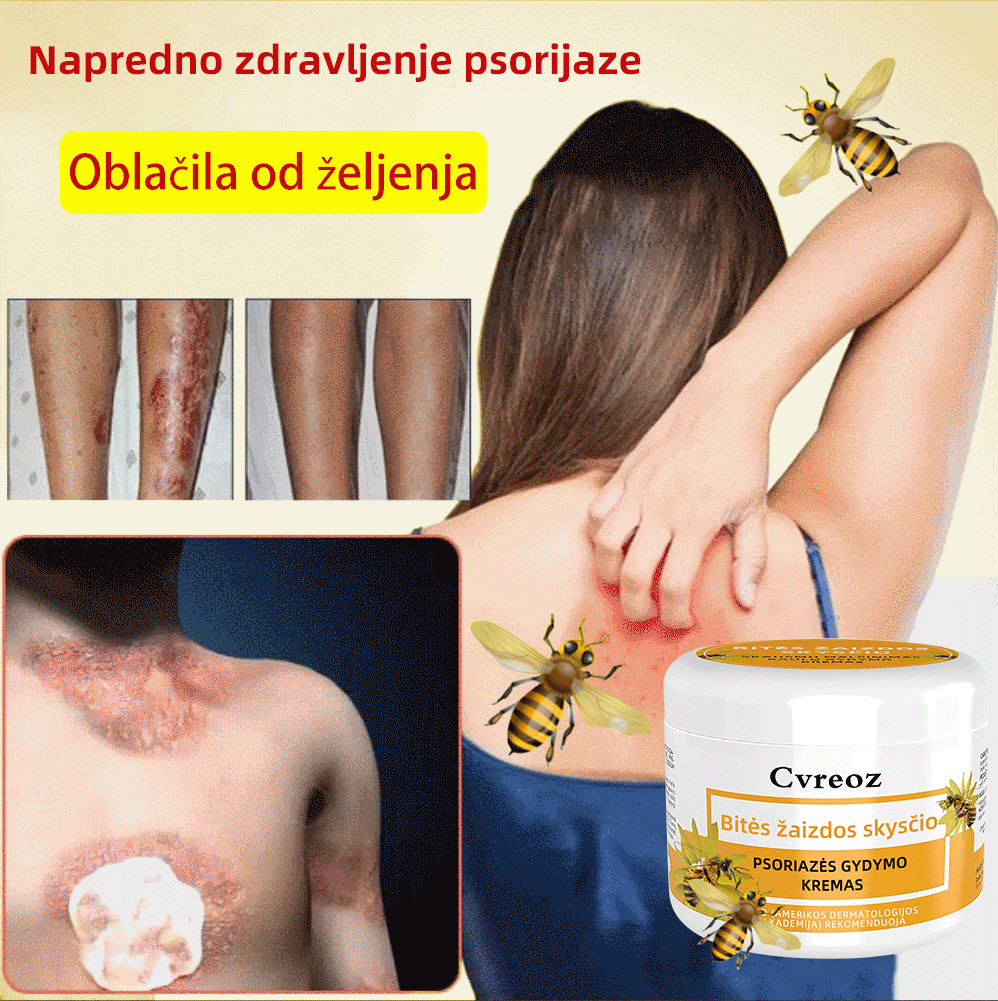 🌈Cvreoz krem za zdravljenje psorijaza z medonosjem (👨⚕Priporoča AAD)🐝🐝