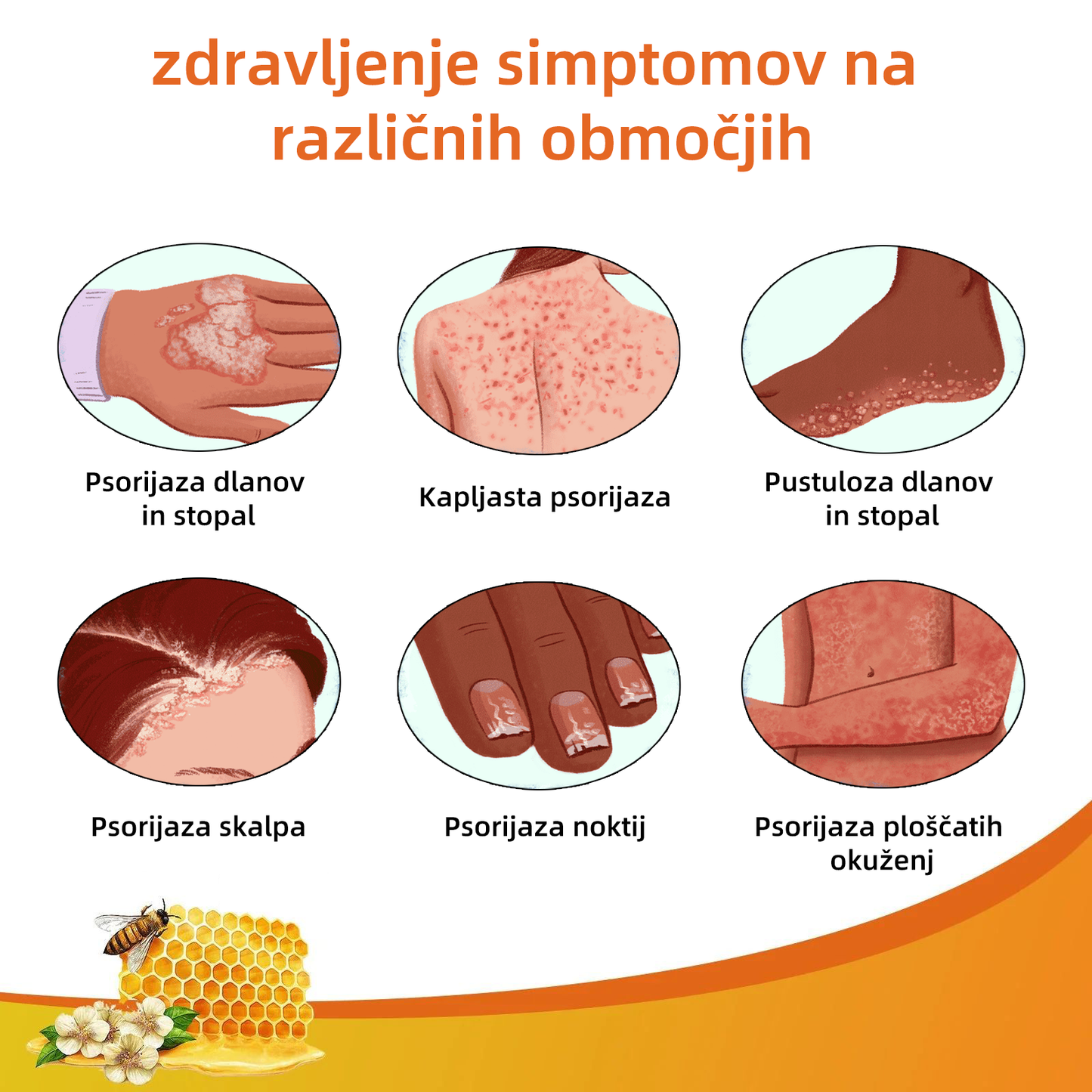 🌈Cvreoz krem za zdravljenje psorijaza z medonosjem (👨⚕Priporoča AAD)🐝🐝