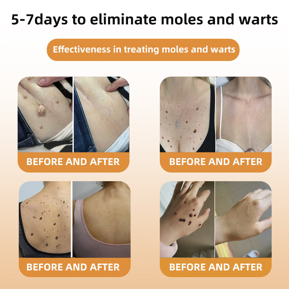 🐹WREE™ Bee Venom Wart & Tag Removal Cream(👨⚕Suitable for all skin types)🐝(🔥Last day promotion 60% off)