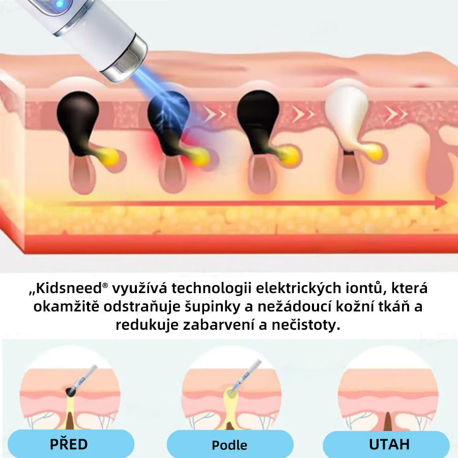 KIDSNEED®💃 Neinvazivno lasersko pero za odstranjevanje kretenj in bradavic - močno🔥🔥🔥Priporočilo Slovenskega dermatološkega društva (SDD)