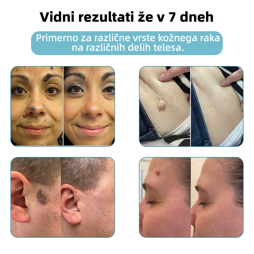 KIDSNEED®💃 Neinvazivno lasersko pero za odstranjevanje kretenj in bradavic - močno🔥🔥🔥Priporočilo Slovenskega dermatološkega društva (SDD)