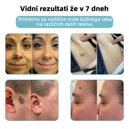 KIDSNEED®💃 Neinvazivno lasersko pero za odstranjevanje kretenj in bradavic - močno🔥🔥🔥Priporočilo Slovenskega dermatološkega društva (SDD)