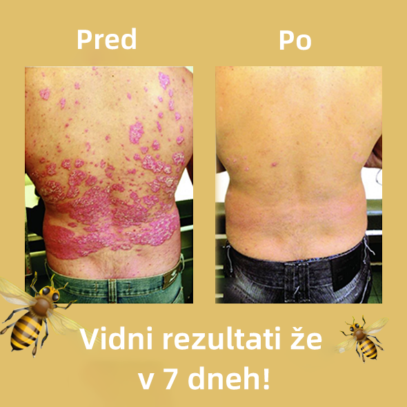 🌈Cvreoz krem za zdravljenje psorijaza z medonosjem (👨‍⚕Priporoča AAD)🐝🐝