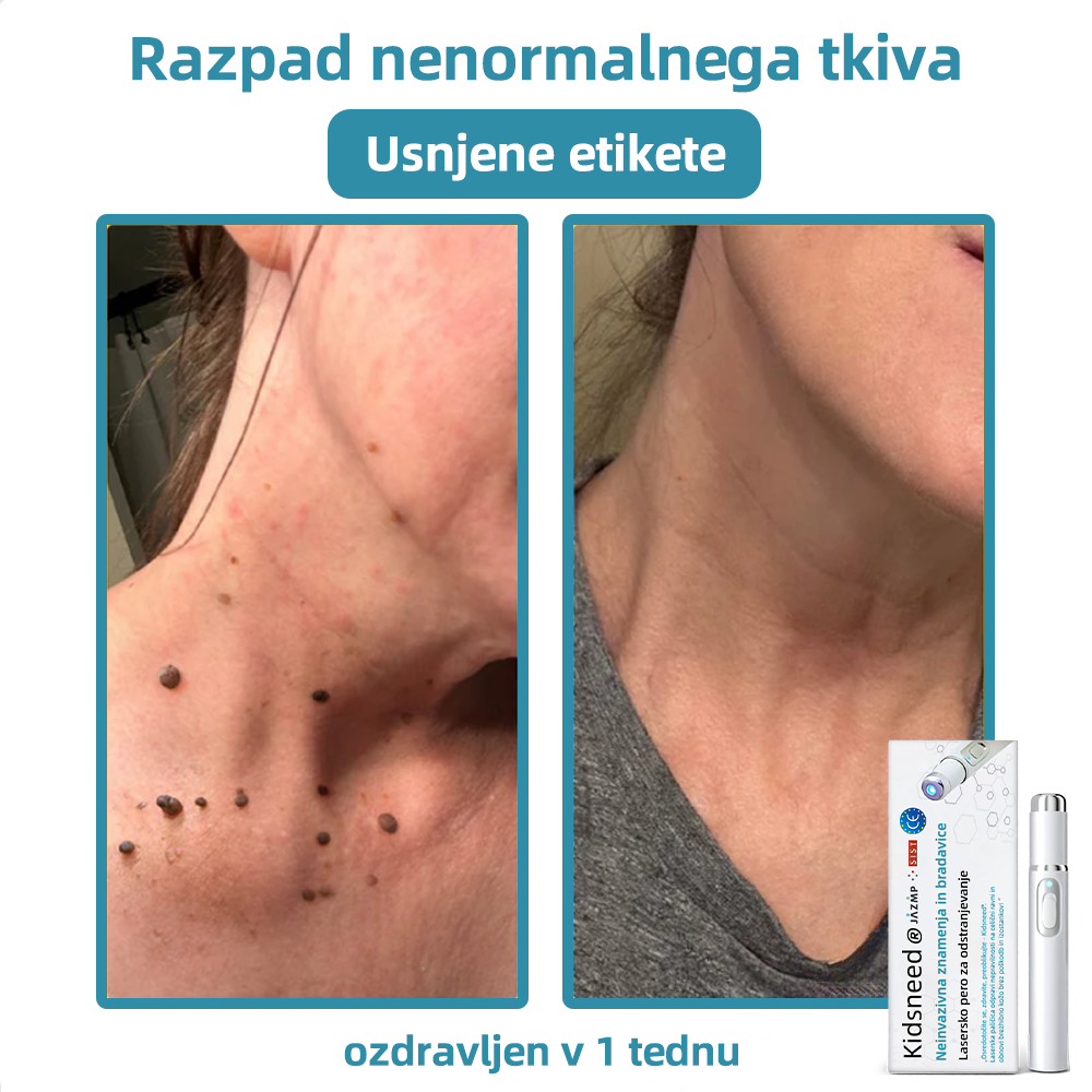 KIDSNEED®💃 Neinvazivno lasersko pero za odstranjevanje kretenj in bradavic - močno🔥🔥🔥Priporočilo Slovenskega dermatološkega društva (SDD)