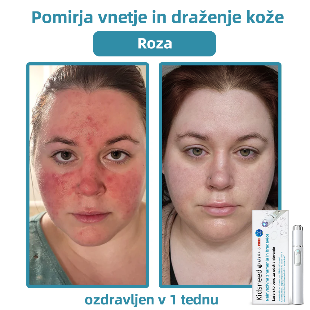 KIDSNEED®💃 Neinvazivno lasersko pero za odstranjevanje kretenj in bradavic - močno🔥🔥🔥Priporočilo Slovenskega dermatološkega društva (SDD)