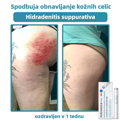 KIDSNEED®💃 Neinvazivno lasersko pero za odstranjevanje kretenj in bradavic - močno🔥🔥🔥Priporočilo Slovenskega dermatološkega društva (SDD)