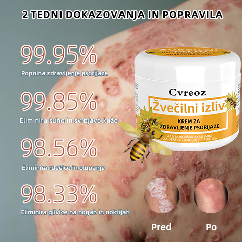 🌈Cvreoz krem za zdravljenje psorijaza z medonosjem (👨‍⚕Priporoča AAD)🐝🐝