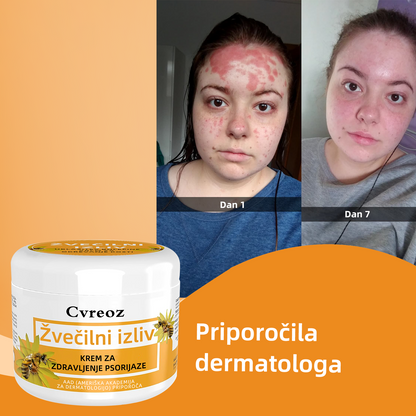 🌈Cvreoz krem za zdravljenje psorijaza z medonosjem (👨‍⚕Priporoča AAD)🐝🐝